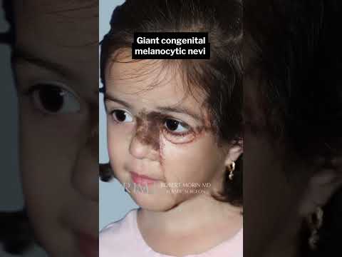 Pediatric Patient’s Journey: Overcoming Giant Melanocytic Congenital Nevus